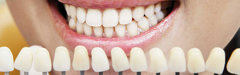 Protesi dentarie Palermo