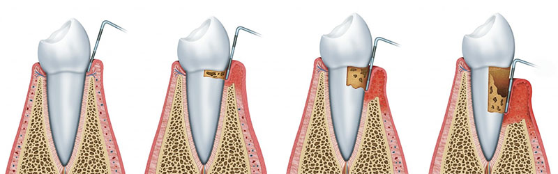 Preventivi denti fissi Sicilia